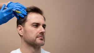 PRP hair treatment