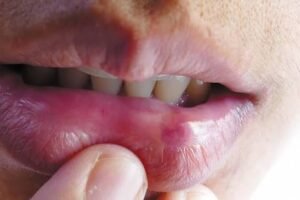 Burning Mouth Syndrome Supplements for Nutritional Deficiencies